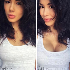 Photos of amazing breast lift up results